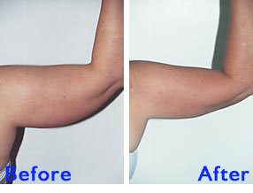 Liposuction Arms